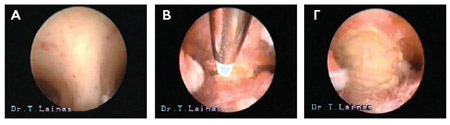 Bicornuate uterus